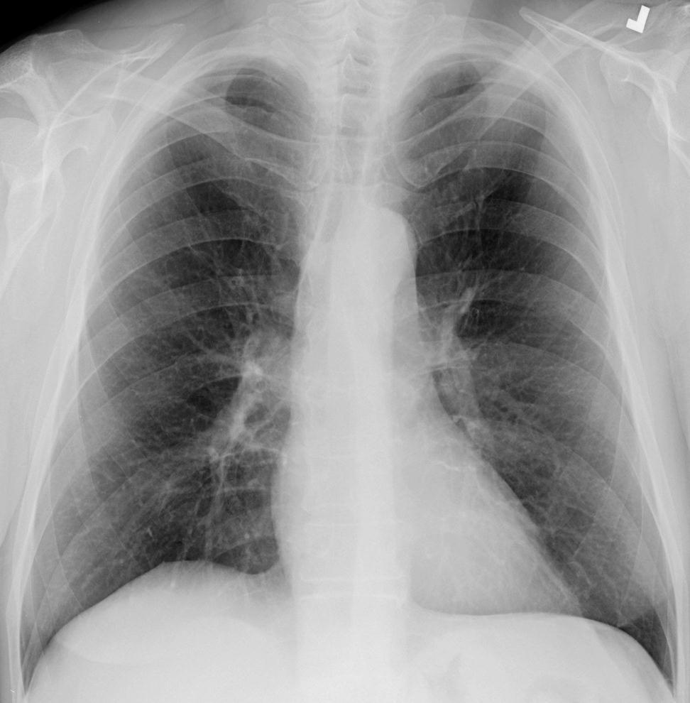 Missed Lung Cancers : JHM Austin et al. Rad 1992;182:115-122 Size: 0.6 3.