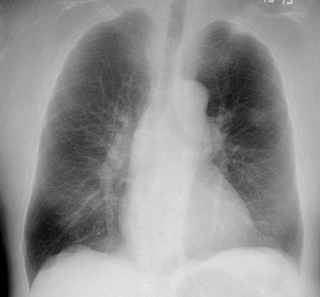 Lung Carcinoma 74 y/o