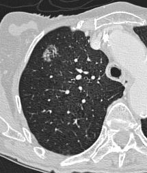 Adenocarcinoma Up to 50% of lung cancers 55% present as peripheral nodule, often