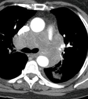 Small-Cell Carcinoma 15-20% of lung cancers Early metastases, mediastinal