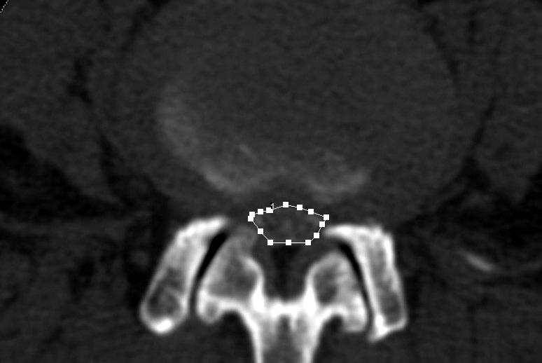 endplate. The pathologic D-CSA was measured at the disc level.