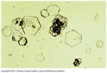 Cystine crystals Acidic urine Metabolic disorder: Cystinosis / Cystinuria Inherited amino acid transport disorder