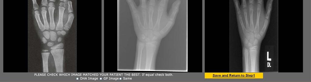 Radiologist chooses which method (G&P or CAD) provides the better assessment by checking the 3 options: G&P, DHA, or both equally Clicking on this link