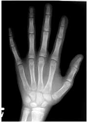 Left hand/wrist radiograph 2.