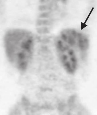A C, Images from combined PET/CT show low-density lesions (arrows, A and C) in spleen on coronal CT image (A).