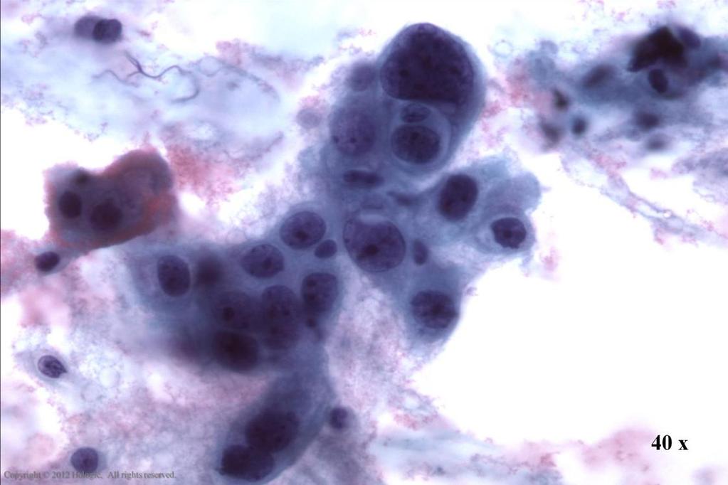 Morphology I Slide: 106 Endocervical Adenocarcinoma Loose cluster of large malignant cells exhibiting rounding up.