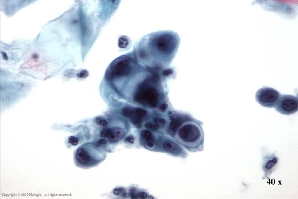 Morphology I Slide: 107 Endocervical Adenocarcinoma Loose cluster of