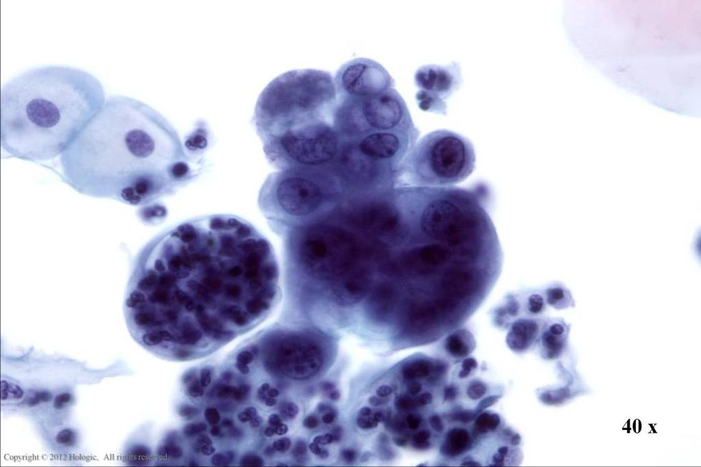 Morphology I Slide: 110 Endometrial Adenocarcinoma Dense cluster of malignant cells with
