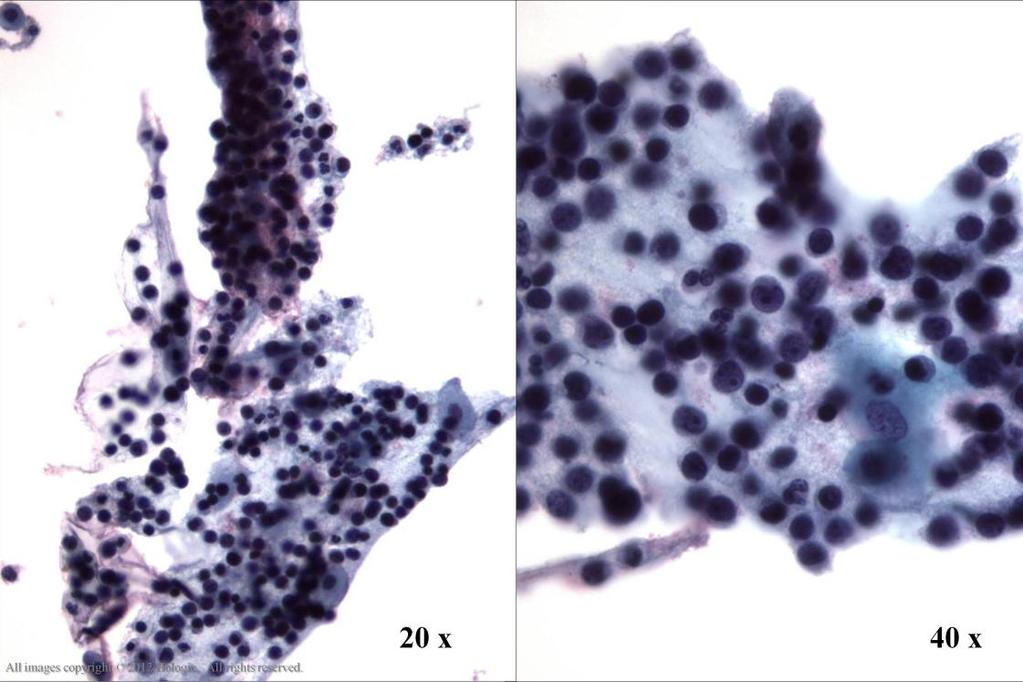 Morphology I Slide: 114 Malignant lymphoma, metastatic to cervix Necrotic debris with numerous single