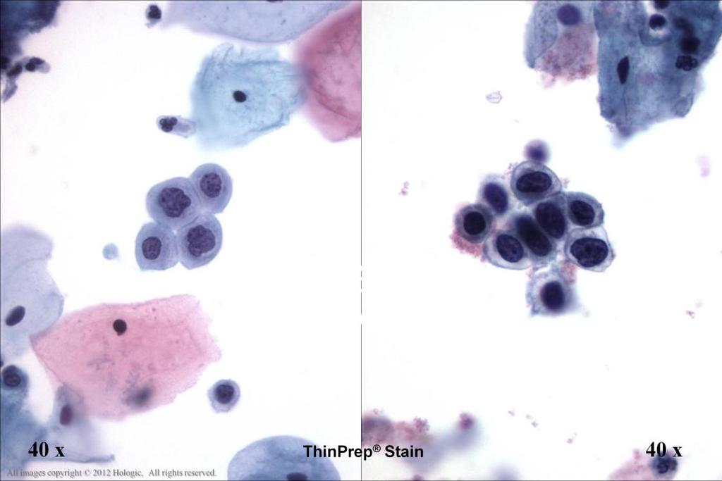 Morphology I Slide: 13 TP Characteristics Variability in Nuclear Staining - ThinPrep Stain Left image: Dependent upon patient biology, the chromatin of the dysplastic cells can appear hypochromatic.