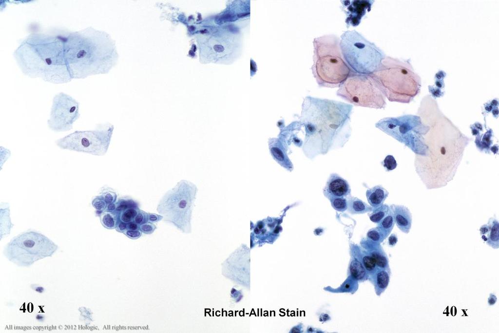 Morphology I Slide: 14 TP Characteristics Variability in Nuclear Staining Richard-Allan stain Left image: Here is another example of hypochromatic appearing nuclei in a case of