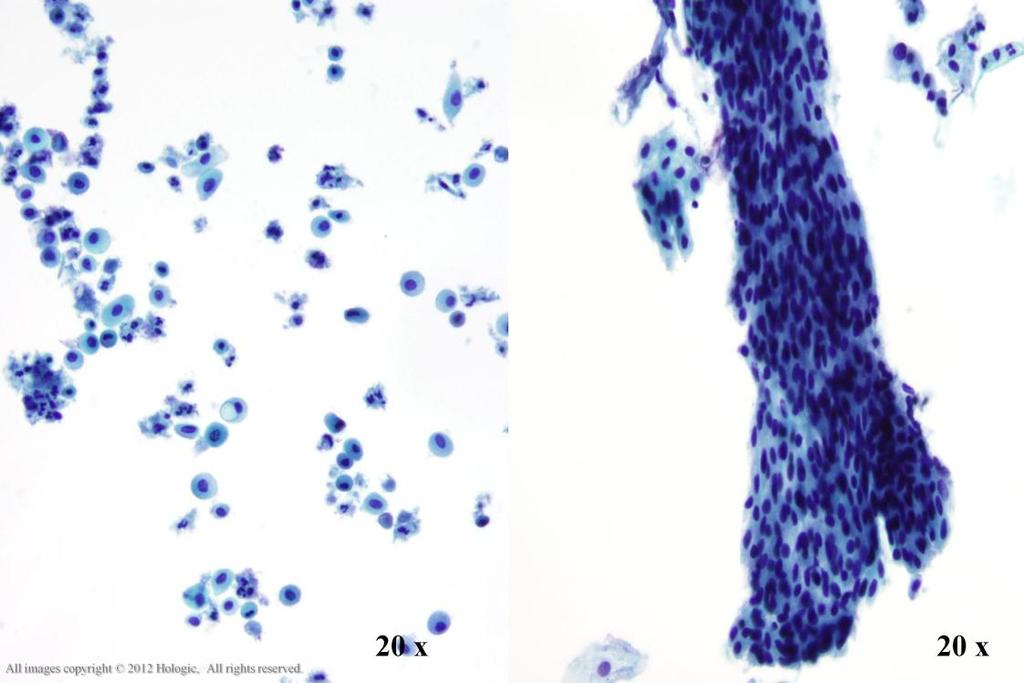 Morphology I Slide: 48 Atrophy Sheets and single parabasal cells are