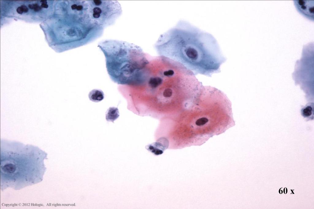 Morphology I Slide: 52 Trichomonas vaginalis Inflammatory cell changes, including peri-nuclear halos, cytoplasmic vacuolization and bichromatic staining are useful in pattern recognition.