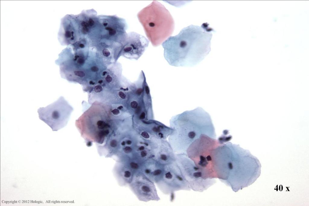 Morphology I Slide: 56 Reactive Changes Due to Inflammation Reactive squamous cells with engulfed WBCs associated with