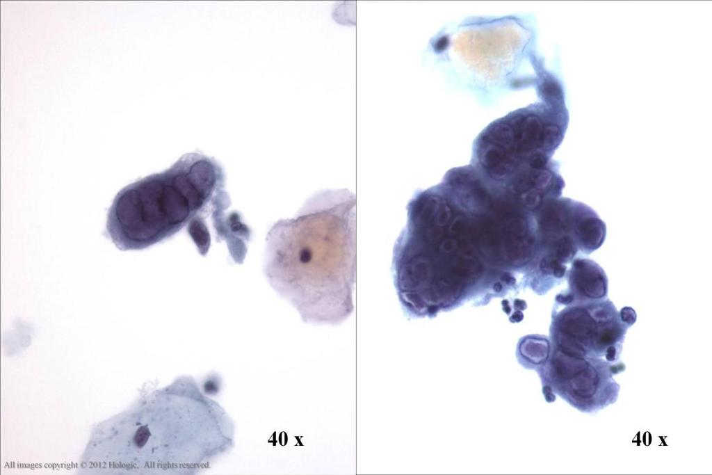 Morphology I Slide: 62 Herpes Simplex Virus Multinucleation with nuclear molding and ground glass nuclei are seen in these