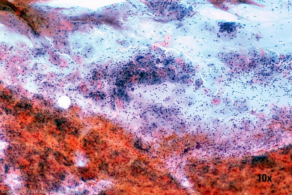 Morphology I Slide: 7 Conventional Pap (CP) smear Microscopically, the uneven