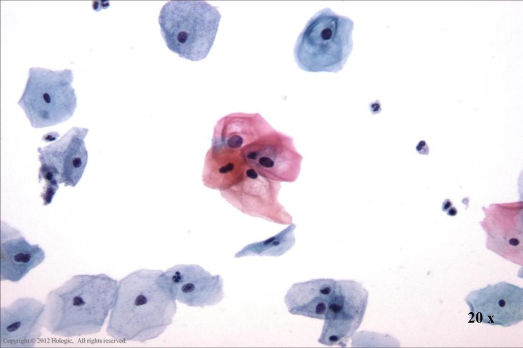 Morphology I Slide: 72 ASC-US Small group of squamous cells