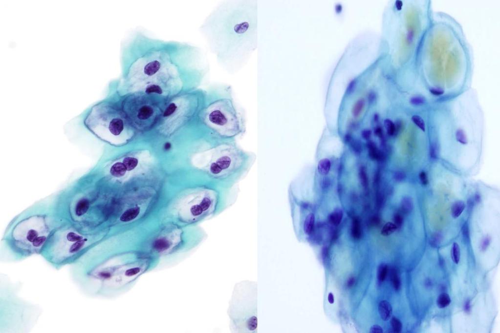 Morphology I Slide: 80 Look-Alike: HPV Cavitation vs. Vacuoles Left image: Dense, sharp and irregular cavitations caused by viral particles are evident.