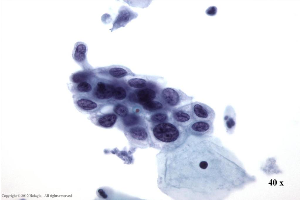 Morphology I Slide: 83 HSIL Dense immature cytoplasm, increased N/C