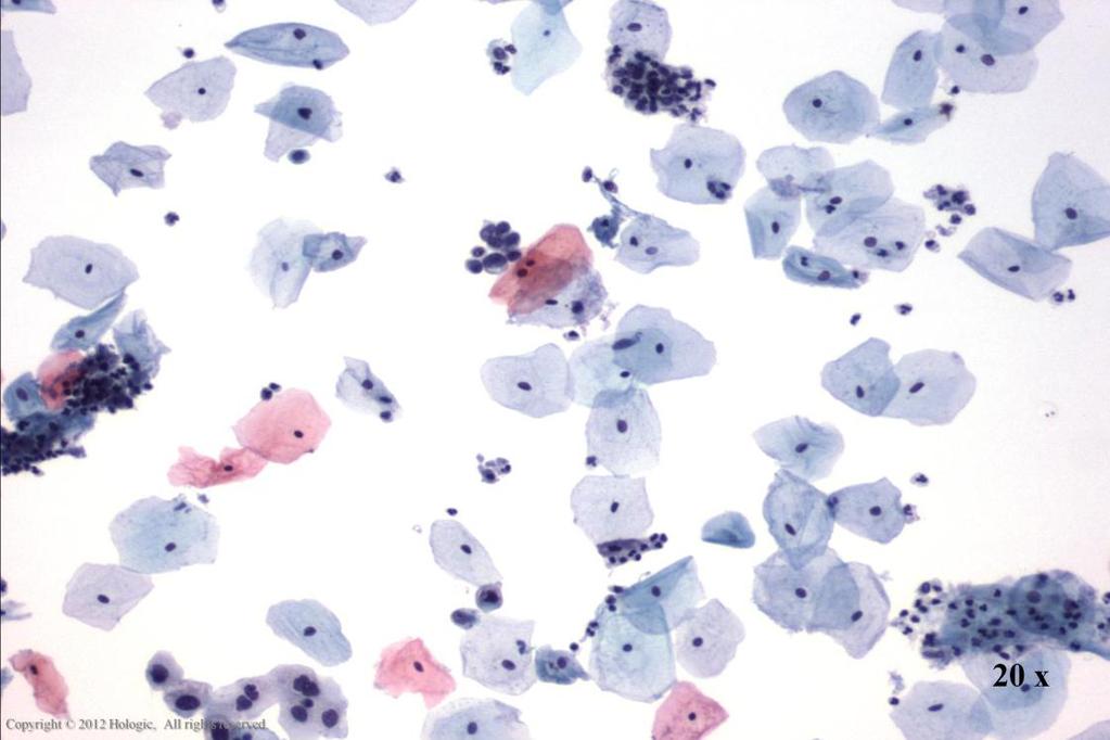 Morphology I Slide: 84 HSIL At low power, abnormal single cells will serve as a clue and upon
