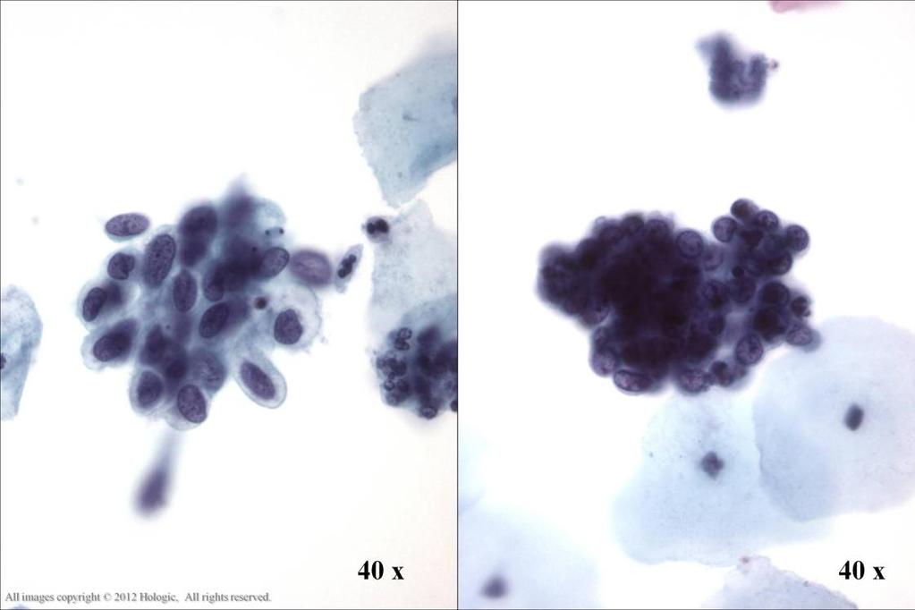 Morphology I Slide: 86 Look-Alike: HSIL vs. Endometrials Left image: Groups of HSIL cells have less depth-of-focus, more distinct cytoplasmic borders and greater nuclear variability.