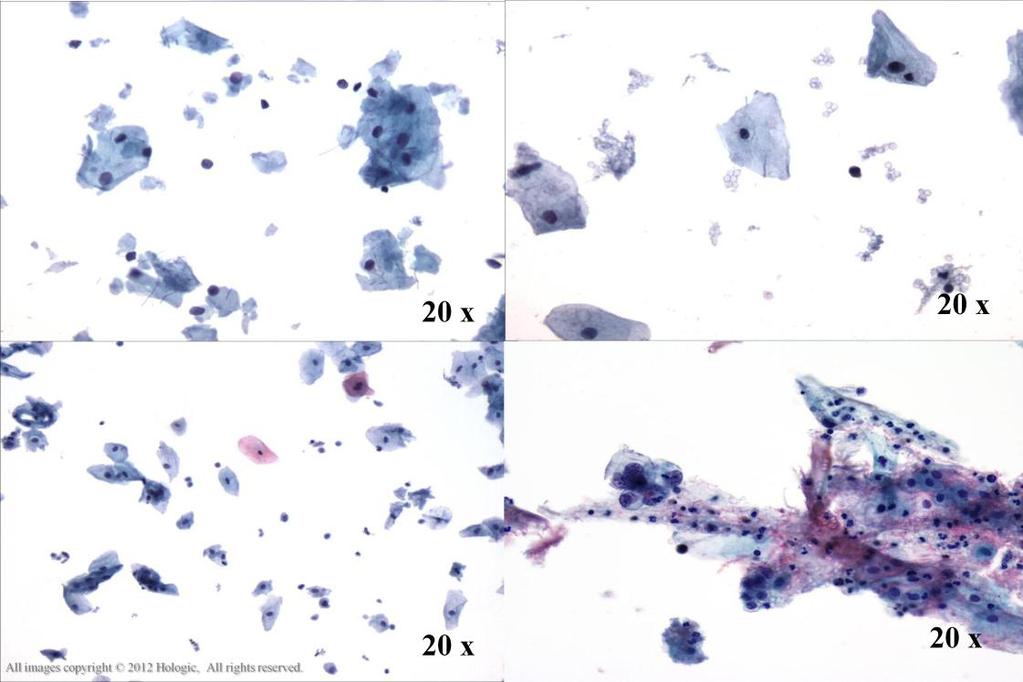 Morphology I Slide: 94 Tumor Diathesis Look-Alikes Cytolysis stripped nuclei and cytoplasmic debris are present.