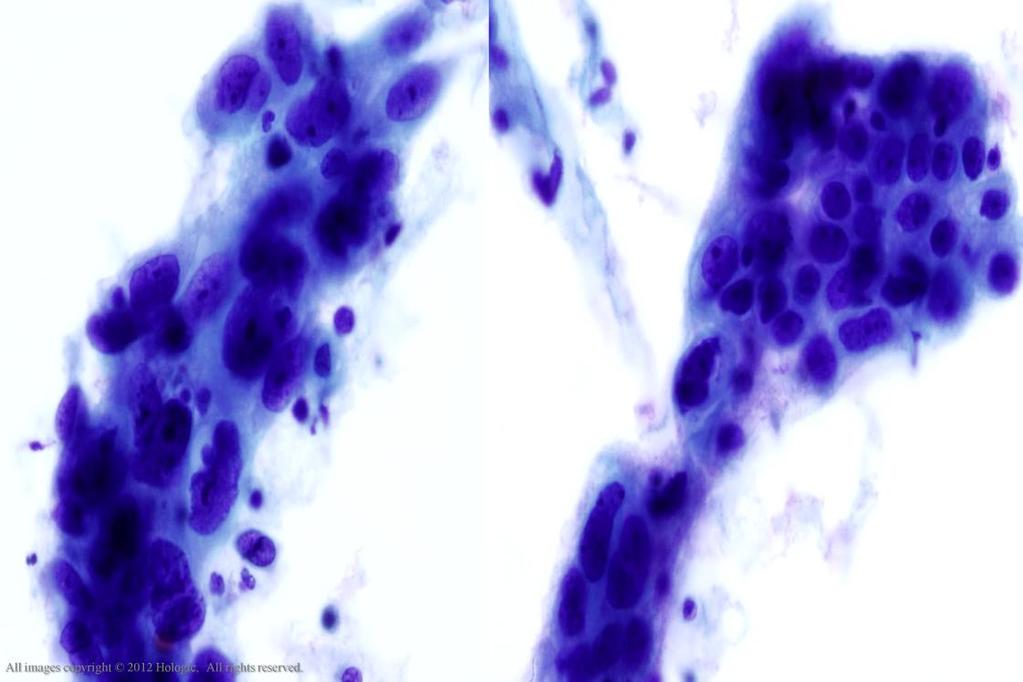 Morphology I Slide: 95 Look-Alike: Non-Keratinizing Squamous Cell Carcinoma vs.