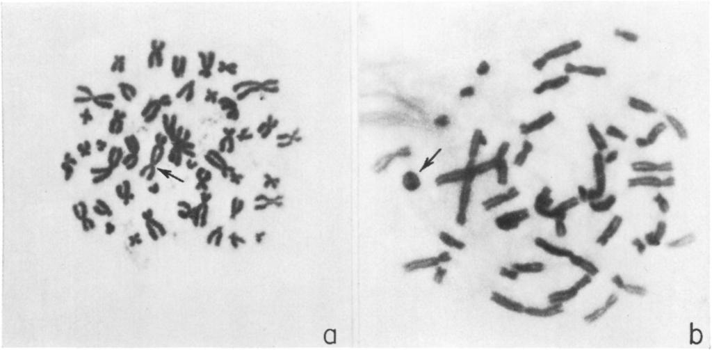 HUMAN CHROMOSOME ABERRATIONS 47 FIG. 1. Aberrant chromosomes of cells from irradiated men. a, Cell with dicentric chromosome; b, cell with ring chromosome (and also a dicentric).