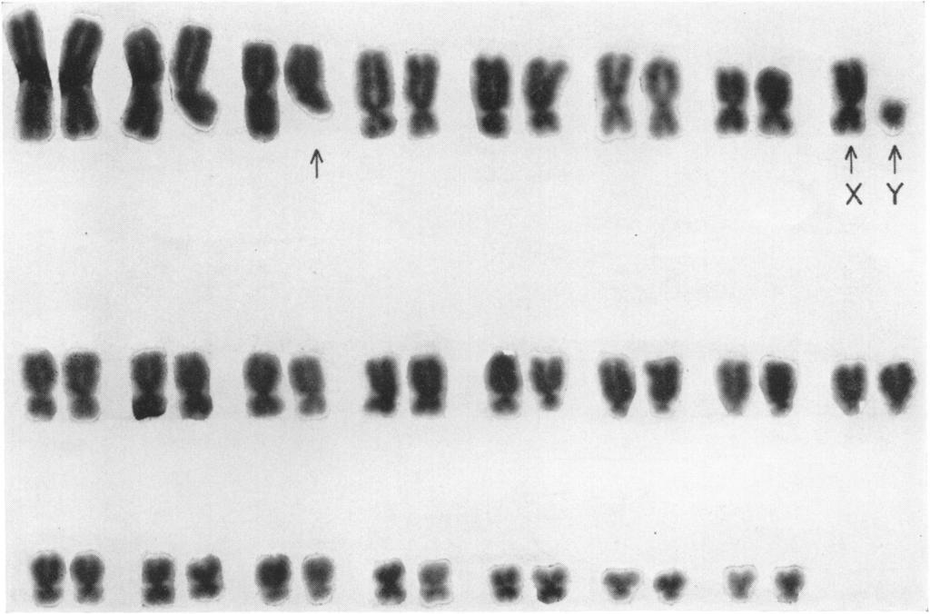 48 BENDER AND GOOCH FIG. 2a FIG. 2. Aberrant karyotypes of cells from irradiated men. a, Grossly normal cell showinig deletion; b, cell showing possible pericentric inversion.