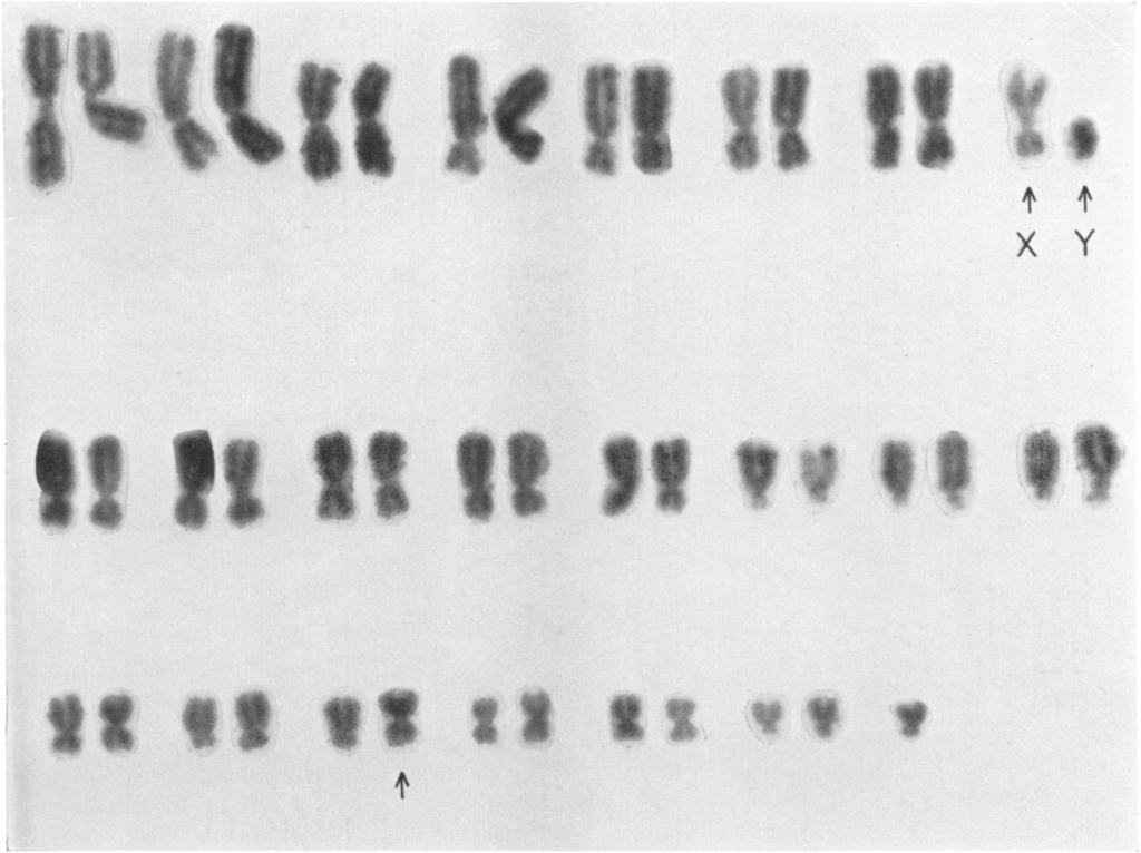 HUMAN CHROMOSOME ABERRATIONS 49 FIG. 2b the cell population. In addition, cell selection may well operate to increase or decrease the frequencies of various aberration-bearing clones of cells.