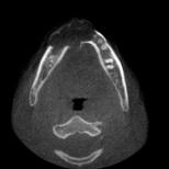 can displace and resorb teeth A hemorrhagic aspirate favors the diagnosis of ABC Advanced imaging: CT Aneurysmal Bone Cyst Case 1 Aneurysmal Bone Cyst