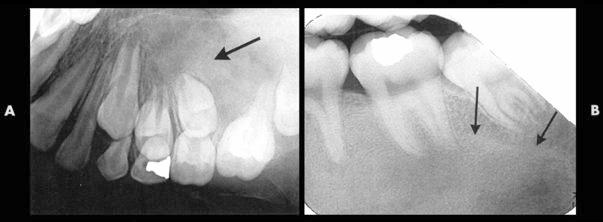 Maxillary lesions may expand into the maxillary sinus 4. Teeth may be displaced 5.
