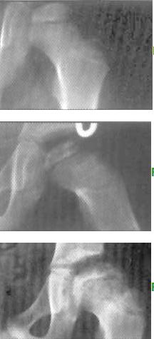 Evolution of LCPD Early on, you can have normal frontal pelvis radiographs. Frontal Pelvis views of Femoral Head Three Stages of LCPD: 1.