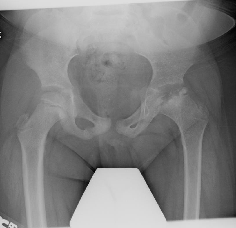 2 years later, hip radiograph showed: continued