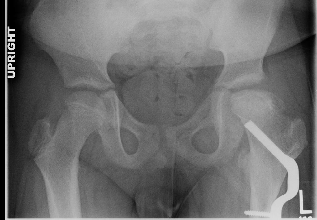 Frontal Pelvis at Three Year Follow Up AP View Pelvis Image courtesy of Dr.