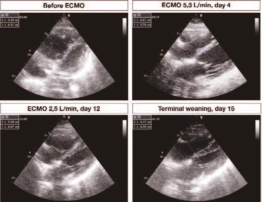 Veno-Arterial ECMO in Severe Acute Right Ventricular Failure Before ECMO ECMO 5.3 L/min, day 4 ECMO 2.5 L/min, day 12 Terminal weaning, day 15 Figure 1.
