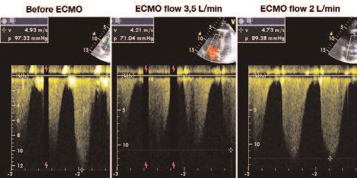 BELOHLAVEK, et al. Before ECMO ECMO flow 3.5 L/min ECMO flow 2 L/min Figure 3.