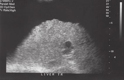 Transverse views of the liver demonstrate surface nodularity in (A) (white
