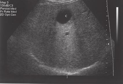 Liver Pathology 37 LONG Figure 2-16 Epithelial cyst.