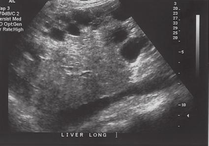 38 hapter 2: The Liver I Figure 2-18 Polycystic liver disease. Longitudinal sonogram showing multiple liver cysts () in a patient with advanced polycystic kidney disease. I inferior vena cava.