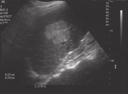 Liver Pathology 43 Figure 2-24 Lipoma.