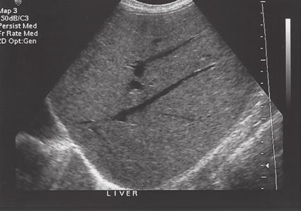 26 hapter 2: The Liver Figure 2-1 Normal Liver.