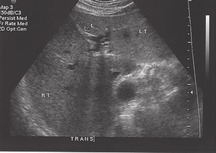 Anechoic structures (white arrows) represent normal vessels.the diaphragm (black arrow) is seen superiorly.