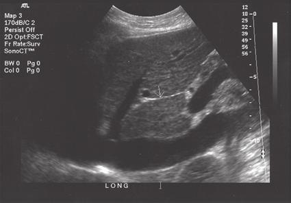 The falciform ligament (2) is seen within the left lobe.the right kidney (RK) is seen posterior to the right lobe.