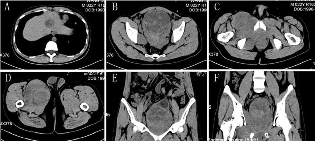 Zhang et al. World Journal of Surgical Oncology 2014, 12:194 Page 2 of 5 Figure 1 Enhanced pelvic computed tomography. (A) Evidence of liver metastasis.