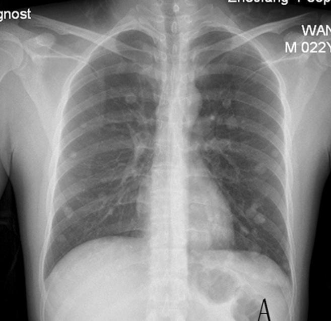 Zhang et al. World Journal of Surgical Oncology 2014, 12:194 Page 3 of 5 Figure 3 Chest radiography. (A) Evidence of lung metastasis. The age of our patient (22 years old) was younger than this range.