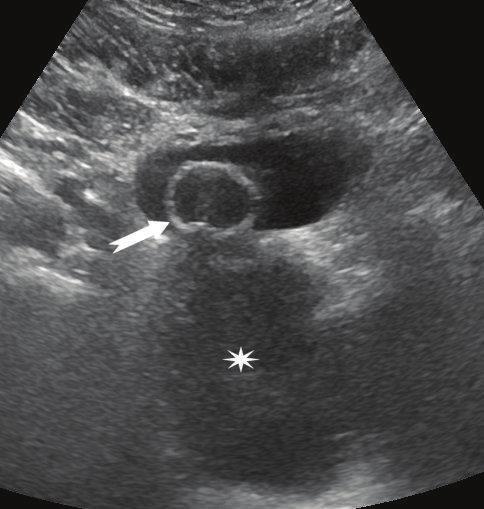 2 Case Reports in Urology Figure 1: Pelvic ultrasound. A large hypoechoic mass (asterisk) is seen in the prostatic loggia. The arrow indicates the urinary catheter.