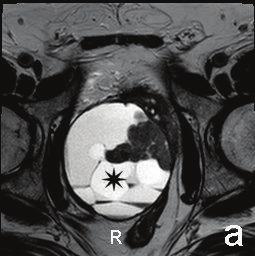 Case Reports in Urology 3 (a) (b) (c) Figure 3: MRI. Axial (a) and sagittal (b) T2-weighted images. Axial precontrast (c) and postcontrast (d) T1-weighted images.
