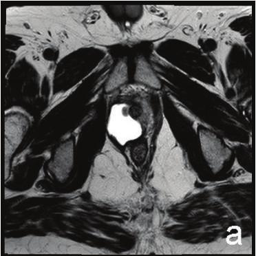 Case Reports in Urology 5 (a) (b) Figure 6: MRI. Postoperative images. Axial T2-weighted (a) and T1-weighted after contrast administration (b) images.