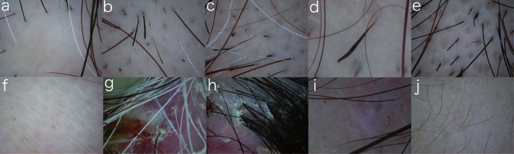CME Trichoscopy: a new frontier for the diagnosis of hair diseases cicatricial (+) alopecia Pustule and/or Hair tufting ( 6 hairs) (+) Neutrophilic or mixed folliculitis decarvans/tufted